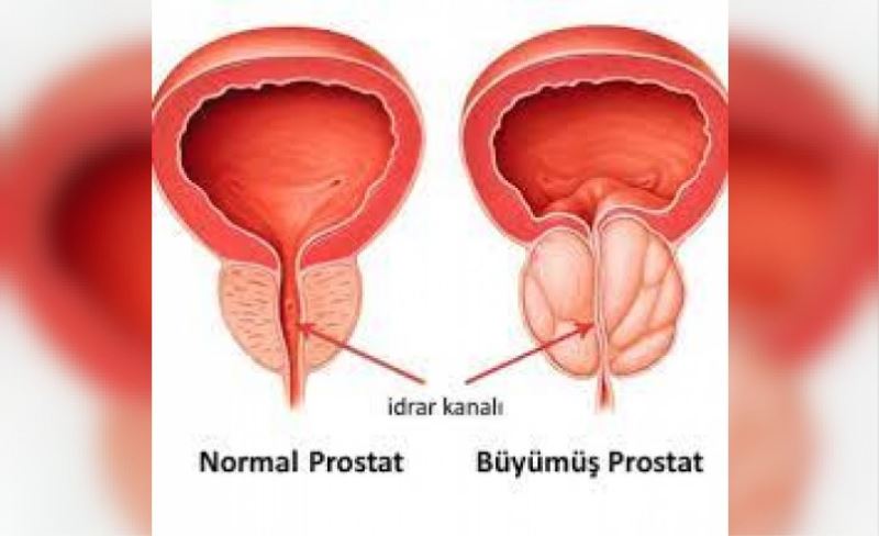 Prostat Hastalıkları Tanı Ve Tedavileri